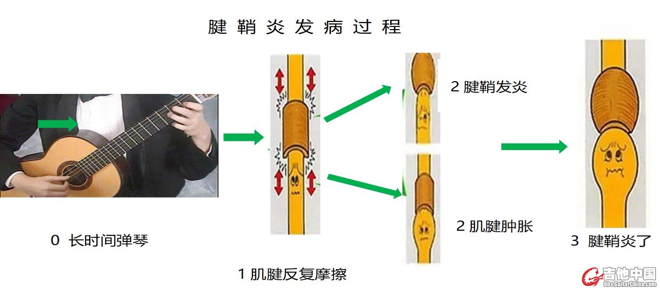 图3  腱鞘炎发病机理