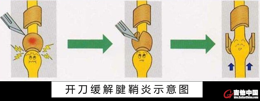 图6  腱鞘炎手术疗法